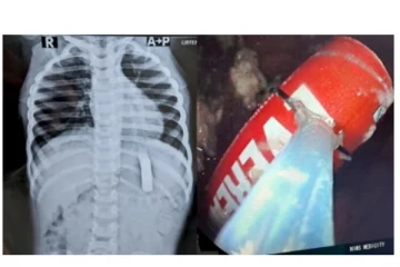 டிவி ரிமோட் பேட்டரியை விழுங்கிய 2 வயது குழந்தை... - அடுத்து நடந்தது என்ன? - அதிர்ச்சி சம்பவம்...!