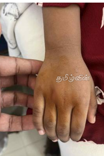 மானிப்பாய் பிரதேச சபையின் பொறுப்பற்ற செயல் - சிறுமியின் கையை பதம் பார்த்த குரங்கு | Monkey Attacks Girl In Manipay