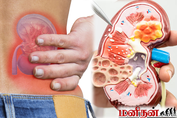 Kidney Stone: சிறுநீரக கற்களால் அவதிப்படுறீங்களா? எளிதாக கரைக்கும் உணவுகள் இதோ | Foods Use To Dissolve Kidney Stone Kidney Stone: சிறுநீரக கற்களால் அவதிப்படுறீங்களா? எளிதாக கரைக்கும் உணவுகள் இதோ | Foods Use To Dissolve Kidney Stone