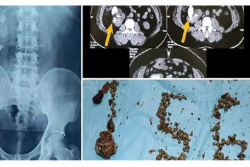 3 மணிநேர சிகிச்சை.. 156 சிறுநீரக கற்களை அகற்றி மருத்துவர்கள் சாதனை