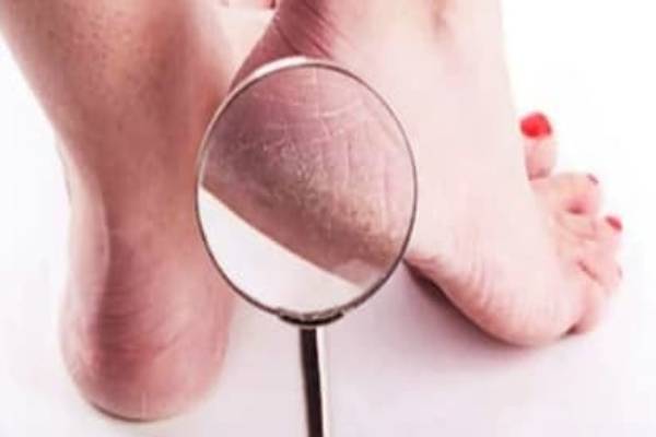 வேர்க்கடலை தோலை இனி வீசாதீங்க - குதிகால் வெடிப்பிற்கு தீர்வு | Cracked Heels Solution To Peanut Skin Paste Beauty