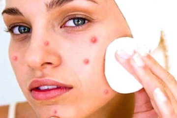 முகப்பரு பிரச்சனையால் அவதியா? இதை சாப்பிடுங்க குணமாகிடும்...!