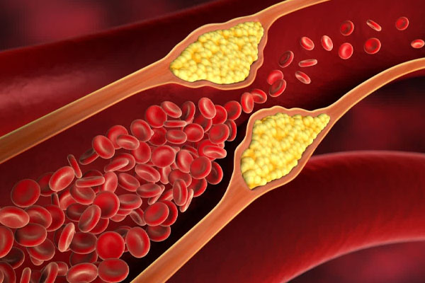 எல்டிஎல் கொழுப்பின் அளவை அதிகரிக்கும் உணவுகள் | Foods That Increase Ldl Cholesterol Levels
