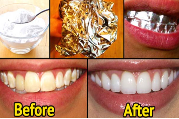 பற்களில் மஞ்சள் கறையால் அசிங்கப்படுகிறீர்களா? 1 மணி நேரத்தில் நிகழும் அற்புதம் | Yellow Teeth Help In Aluminium Paper Teeth