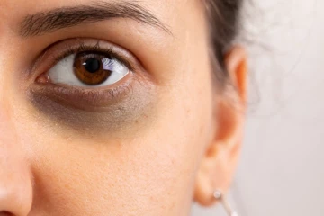 கருவளையம் உங்கள் முகத்தை பாழாக்குகின்றதா? இதனை போக்க இதோ சூப்பரான டிப்ஸ்!