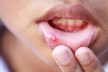 வாய்ப்புண்ணால் அவதியா? ஒரே நாளில் குணமாக இதை செய்தால் போதும்