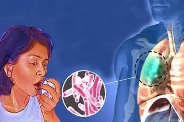 ක්ෂය රෝගය ව්‍යාප්ත වීමේ අවධානම් තත්ත්වයක්..