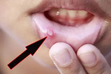 வாய்ப்புண் ஒரே நாளில் குணமாக! எளிதான இந்த விடயத்தை செய்தால் போதுமே