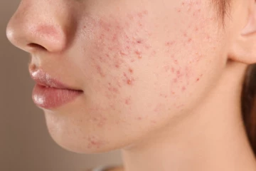 பருக்களை அடியோடு அழிக்க வேண்டுமா? இதோ அட்டகாசமான எளிய வழிகள்