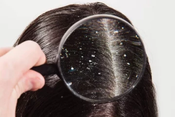 முடி அழகை கெடுக்கும் வெள்ளை பொடுகு - வீட்டிலேயே நிரந்தர தீர்வு பெறுவது எப்படி?