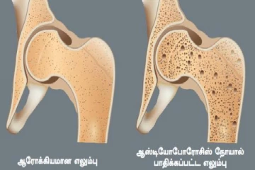 உலக எலும்பு நெய்யரி விழிப்புணர்வு தினம் : சித்தமருத்துவத்தின் இயற்கை வழிகாட்டல்