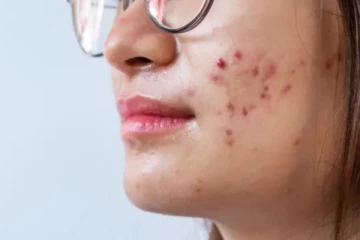 முகப்பருவை அலட்சியமாக விட வேண்டாம் - தோல் புற்றுநோயாக மாறும் அபாயம்