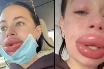 சத்திர சிகிச்சை மூலம் உதடை அழகாக்க செய்த வேலையால் நேர்ந்த கதி!!