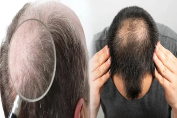 பருவாகால முடி உதிர்விற்கு இந்த உணவுகள் சாப்பிட்டால் வழுக்கத்தலையிலும் முடி வருமாம்!