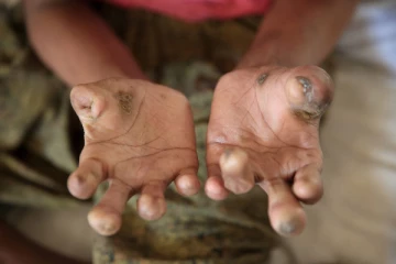 ලංකාවෙන් තුරන් කරලා තිබූ ලාදුරු ඇතුළු තවත් රෝගයක් යළි හිස ඔසවයි.