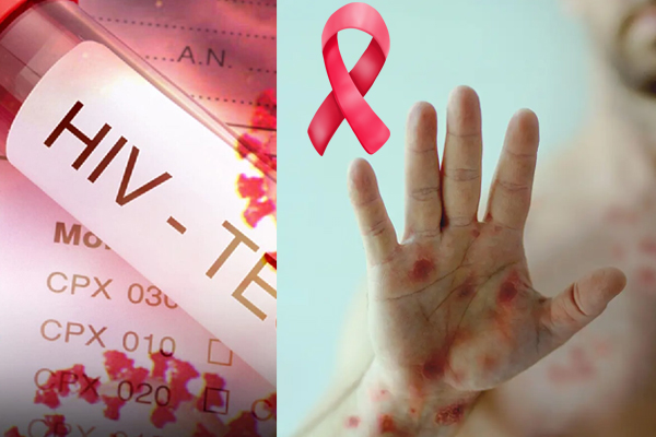 ශ්‍රී ලංකාවෙත් වැඩි වෙමින් පවතින HIV / ඒඩ්ස් (AIDS) - පුවත්
