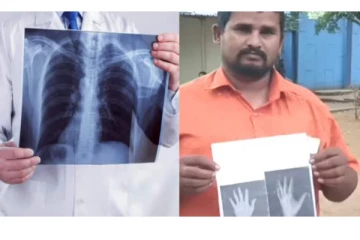 என்ன கொடுமை சார் இது..எக்ஸ்ரேவுக்கு பதில் ஜெராக்ஸ் -அரசு மருத்துவமனையில் நடந்த அவலம்!