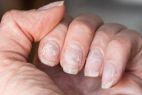 நகம் நொருங்குதா? அப்போ இந்த நோய் உங்களுக்கு இருக்கலாம் | Causes Of Brittle Nails