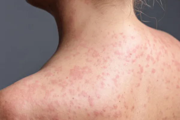 லண்டனில் தீவிரமாக பரவி வரும் தட்டம்மை ; 34 சிறுவர்கள் பாதிப்பு | Measles Spreading Fast In London லண்டனில் தீவிரமாக பரவி வரும் தட்டம்மை ; 34 சிறுவர்கள் பாதிப்பு | Measles Spreading Fast In London