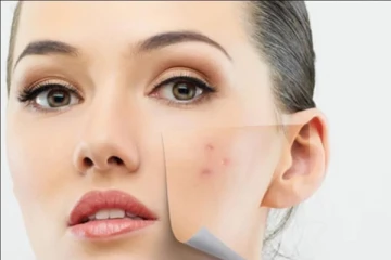 முகப்பரு, வீக்கம் போன்றவற்றை எளியமுறையில் போக்கனுமா? இந்தவொரு பொருளை இப்படி பயன்படுத்துங்கள்