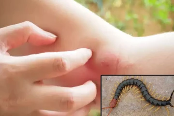 விஷப்பூச்சிகள் கடிக்கு தீர்வு வேண்டுமா? இதோ சில  இயற்கை வைத்தியம்