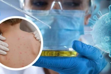 වඳුරු උණ සම්බන්ධයෙන් ප්‍රබල රටක හදිසි තත්ත්වයක්..