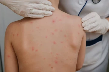 நாட்டில் அதிகரிக்கும் சின்னம்மை தொற்று ; தடுப்பூசிக்கு பற்றாக்குறை