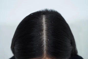 உங்களுக்கு பொடுகுத் தொல்லையா? : இதோ ஒரு எளிய தீர்வு