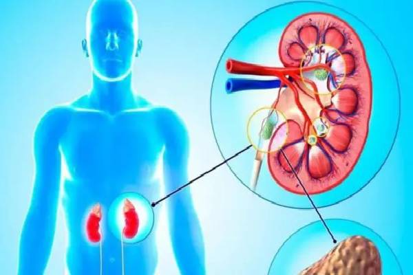 Kidney Stone: சிறுநீரகத்தில் கல் இருக்கா? மறந்தும் கூட இந்த 5 உணவுகளை சாப்பிடாதீங்க | Which Food Do We Not Eat In Kidney Stone