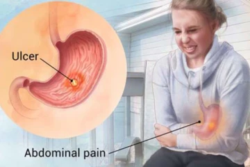 பெப்டிக் அல்சர்... குடல் அழுகினால் ஆபத்து! இந்த அறிகுறியை அலட்சியப்படுத்தாதீங்க...
