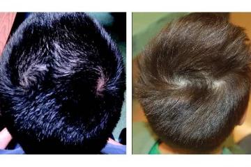 தலையில் இரட்டை சுழி இருந்தால் 2 திருமணமா? ஜோதிடம் சொல்வதென்ன..?