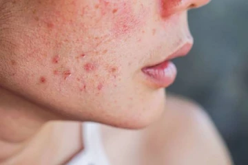 முகத்தில் இருக்கும் பருக்களை போக்க வேண்டுமா? அப்போ இந்த 4 டிப்ஸை யூஸ் பண்ணுங்க