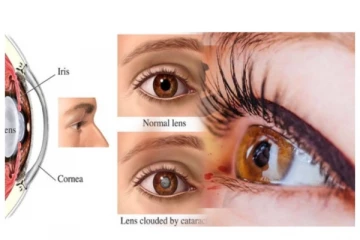 கண்புரை வர காணரங்களும்... தடுக்கும் வழிமுறைகளும்... விரிவாக பார்ப்போம்