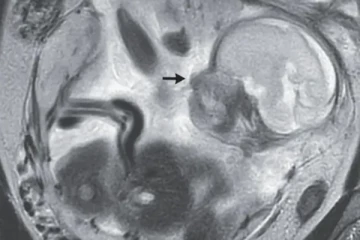 வயிற்றுவலியுடன் அவதிப்பட்ட இளம்பெண்: மருத்துவர்களுக்கு காத்திருந்த அதிர்ச்சி