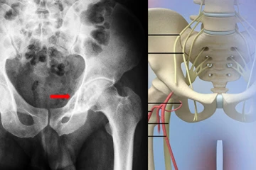 ලිංගභේදය සොයන උකුල් අස්ථියේ සාක්ෂිය.