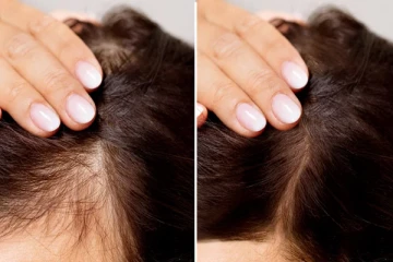 முடி கொட்டுவதை தடுத்து அடர்த்தியான முடி வளர செய்யும் சீரம்... எப்படி வீட்டிலேயே செய்யலாம்?