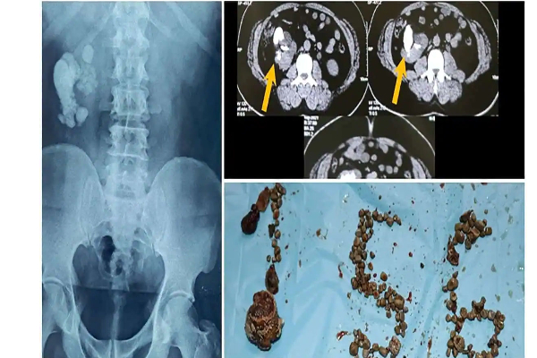 3 மணிநேர சிகிச்சை.. 156 சிறுநீரக கற்களை அகற்றி மருத்துவர்கள் சாதனை | Doctors Removed 156 Stones From The Kidney 3 மணிநேர சிகிச்சை.. 156 சிறுநீரக கற்களை அகற்றி மருத்துவர்கள் சாதனை | Doctors Removed 156 Stones From The Kidney