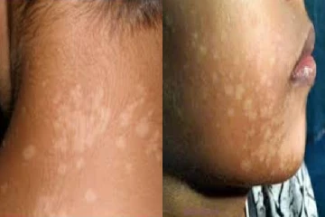 சருமத்தில் வெள்ளை திட்டுக்கள் வந்தால் என்ன செய்ய வேண்டும் தெரியுமா?