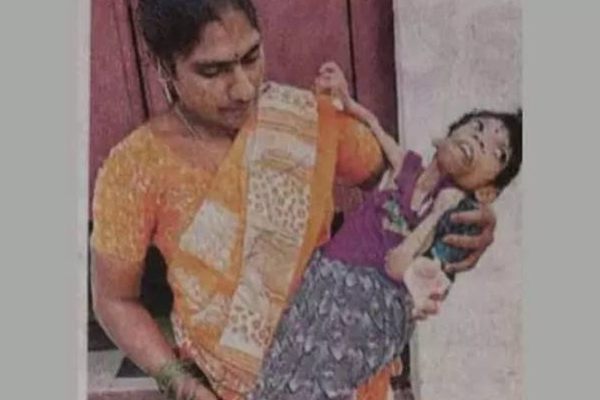 விதித்திர நோயால் எலும்பு கூடாக உள்ள 16 வயது சிறுமி! | 16 Year Old Girl With A Bone Cage Due Rare Disease