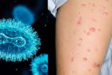 රට පුරාම මංකිපොක්ස් බිය පැතිර යයි..