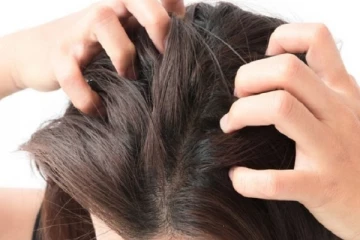 உச்சந்தலை அரிக்கின்றதா... கவலையை விடுங்க!