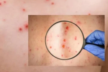 මන්කිපොක්ස් සම්බන්ධයෙන් ශ්‍රී ලංකාව ගත් නවතම ක්‍රමවේදය..