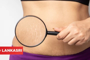 கர்ப்ப காலத்தில் ஏற்படும் Stretch Marksயை எப்படி எளிய முறையில் போக்கலாம்?