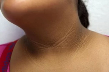 பெண்களே!  கழுத்து கருமையால் கவலையா? இதனை போக்க இதோ சூப்பரான டிப்ஸ்