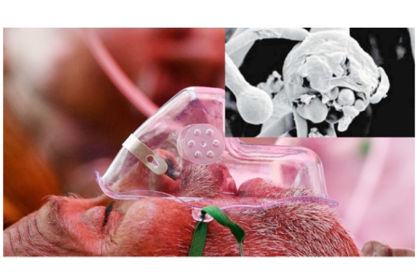 தமிழகத்தில் ஒரே நாளில் கருப்பு பூஞ்சை நோய்க்கு 3 பேர் பலி! | Tamilnadu Samugam தமிழகத்தில் ஒரே நாளில் கருப்பு பூஞ்சை நோய்க்கு 3 பேர் பலி! | Tamilnadu Samugam