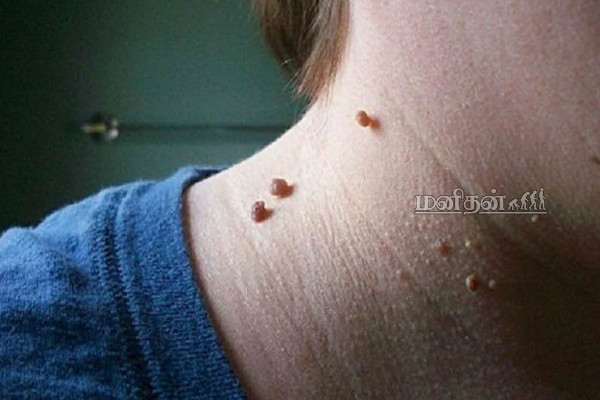 முகம், கழுத்து என மரு அசிங்க படுத்துகிறதா? வலிக்காம உதிர இந்த சாதாரண உணவு பொருட்கள் போதும்! | Tips For Warts Helthy Tips