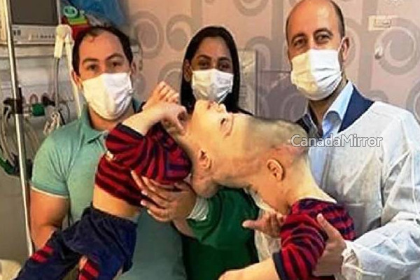ஒட்டிப்பிறந்த இரண்டை சிறுவர்கள்... 33 மணி நேர முயற்சி! மருத்துவருக்கு கிடைத்த சாதனை | Two Conjoined Boys 33 Hours For A Doctor Efforts
