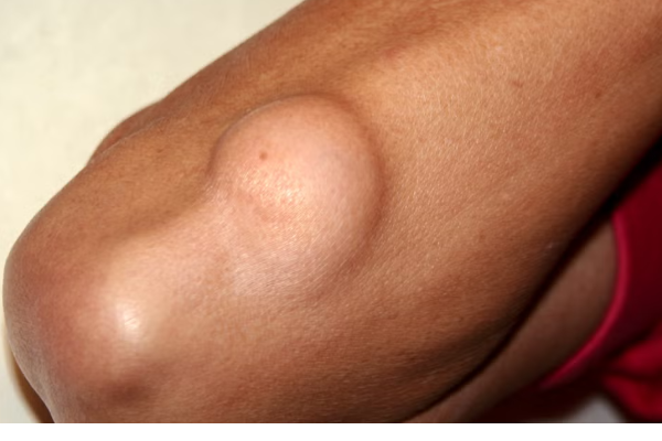 තෙල් ගෙඩි වලට භය වෙන්න ඕනෙද? | Do Lipomas Pose Any Health Risks තෙල් ගෙඩි වලට භය වෙන්න ඕනෙද? | Do Lipomas Pose Any Health Risks