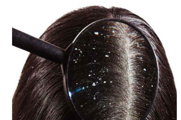 பொடுகு தொல்லையால் அவதிப்படுகிறீர்களா? நிரந்தர தீர்வு இதோ | Will Dandruff Go Away Permanently