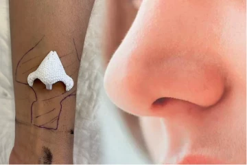 பெண்ணின் கையில் வளர்ந்த மூக்கு! வெற்றிகரமாக முகத்திற்கு மாற்றம்